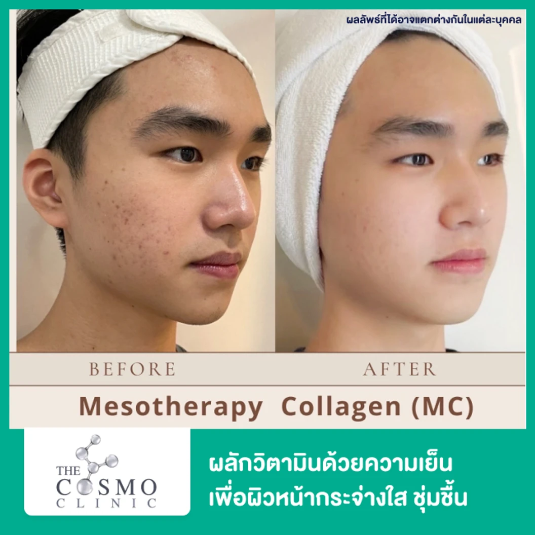 Mesotherapy Collagen ผลักวิตามินด้วยความเย็น เครื่อง Skin Cool เพื่อผิวหน้ากระจ่างใส ชุ่มชื้น กระตุ้นคอลลาเจน 1 ครั้ง ฟรี! มาส์กคอลลาเจน 1 ครั้ง ที่ The Cosmo Clinic