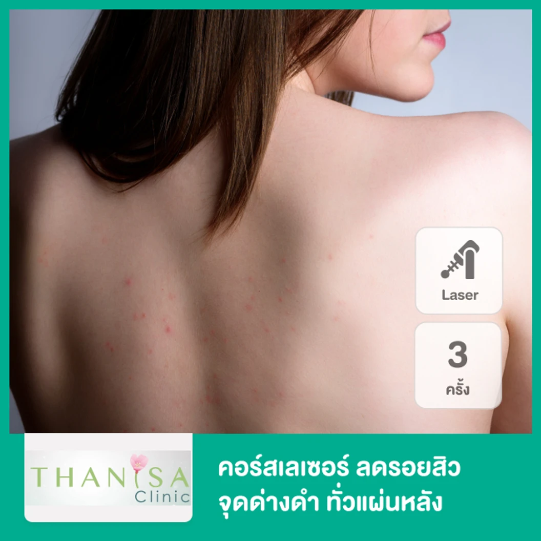 คอร์สเลเซอร์ Q-Switch NdYAG ลดรอยสิว จุดด่างดำ ทั่วแผ่นหลัง 3 ครั้ง ที่ ธานิศาคลินิก