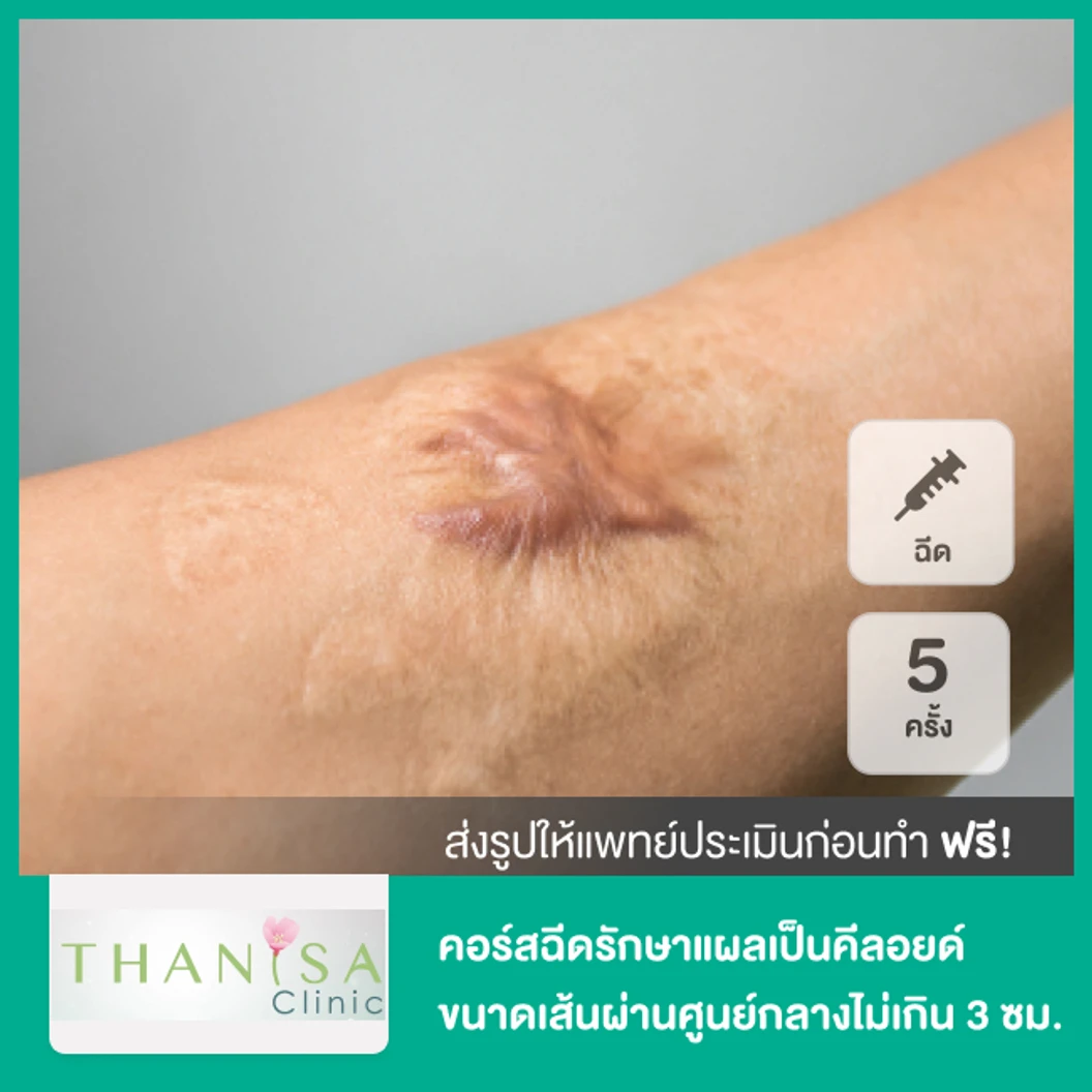 คอร์สฉีดรักษาแผลเป็นคีลอยด์ ขนาดเส้นผ่านศูนย์กลางไม่เกิน 3 ซม 5 ครั้ง ที่ ธานิศาคลินิก