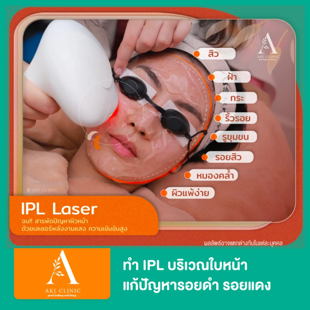 ทำ IPL บริเวณใบหน้า แก้ปัญหารอยดำ รอยแดง รอยสิว ปรับผิวสม่ำเสมอ 1 ครั้ง ที่ Aki Clinic