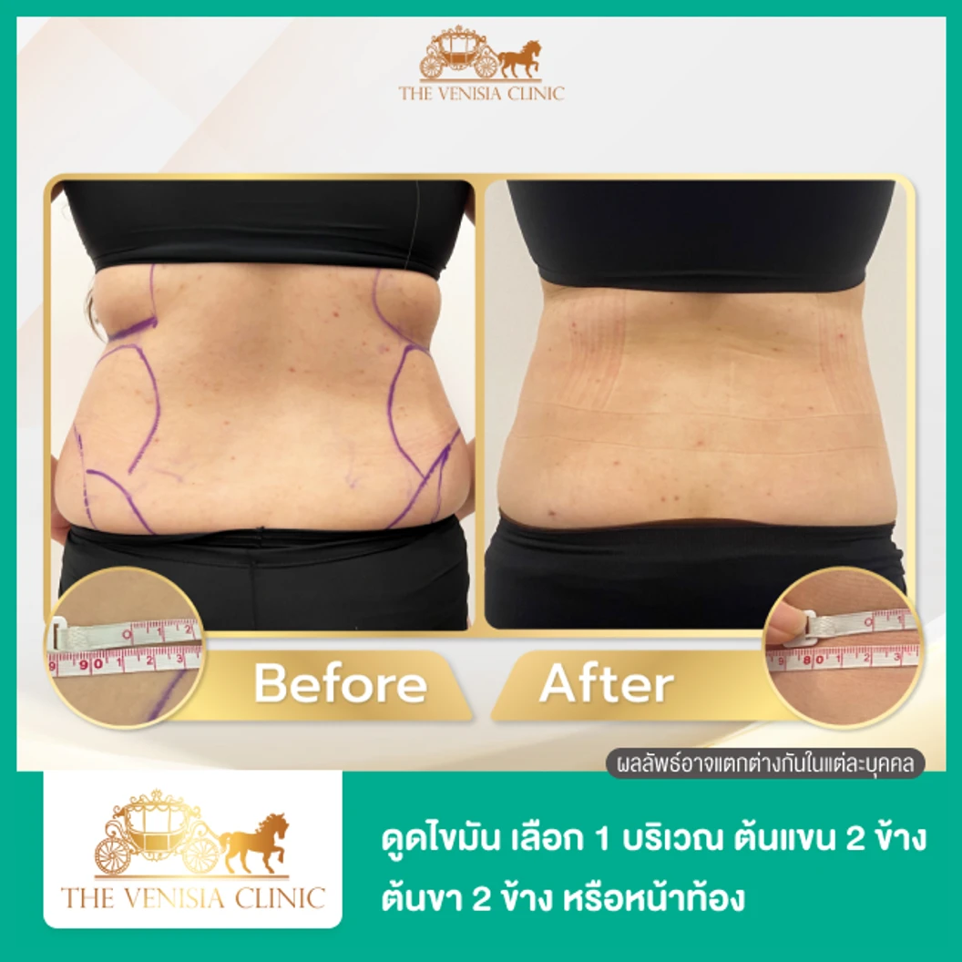 โปรแกรมดูดไขมัน ด้วยเครื่อง Body Jet Evo เลือก 1 บริเวณ ต้นแขน 2 ข้าง ต้นขา 2 ข้าง หน้าท้อง 1 ครั้ง ที่ The Venisia Clinic