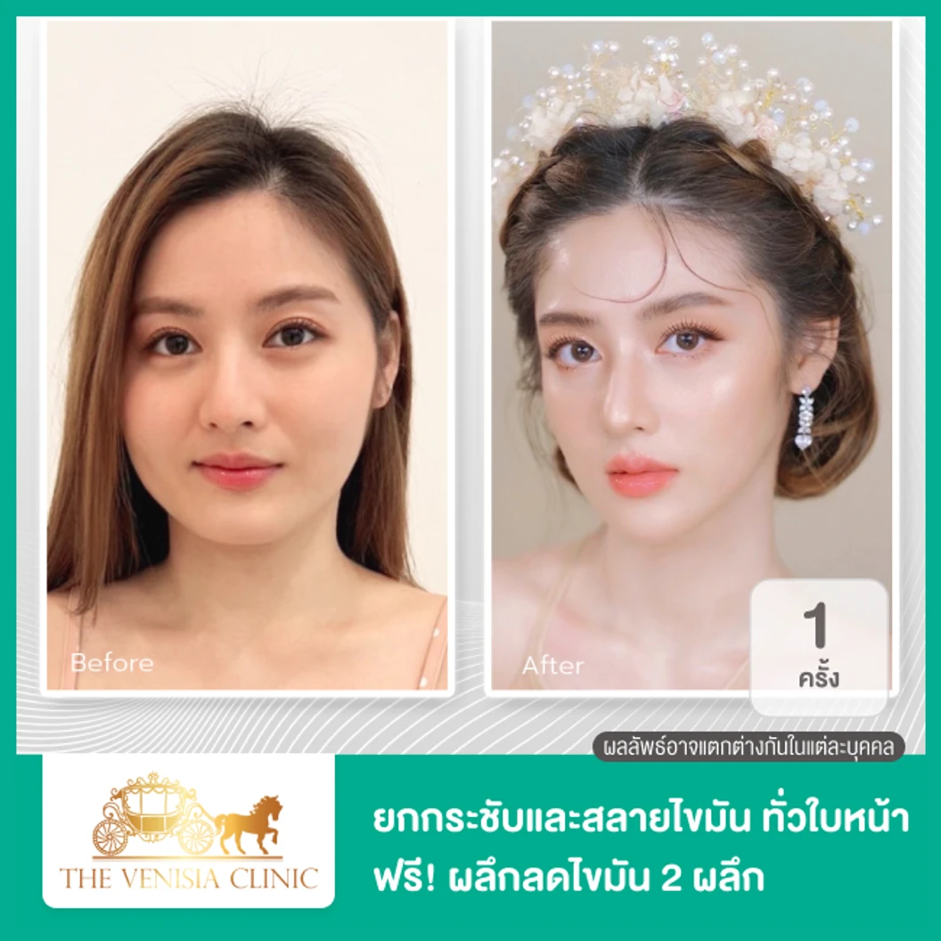 ยกกระชับและสลายไขมัน ด้วย Smart ND Laser บริเวณทั่วใบหน้า 1 ครั้ง ฟรี! ผลึกลดไขมัน 2 ผลึก ที่ The Venisia Clinic