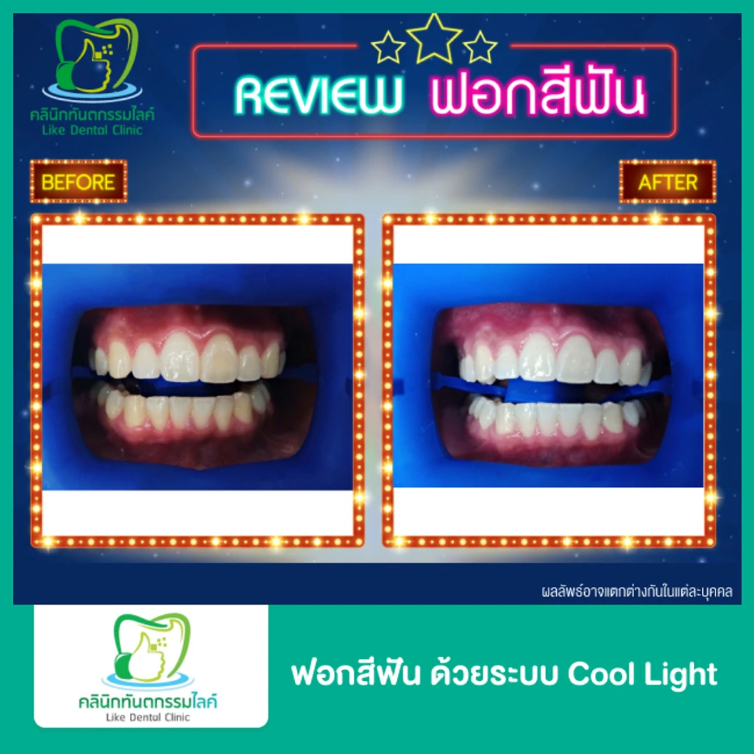 ฟอกสีฟัน ด้วยระบบ Cool Light ที่ Like Dental Clinic