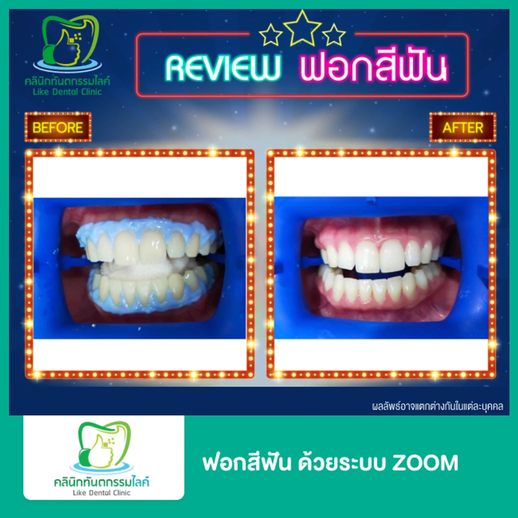 ฟอกสีฟัน ด้วยระบบ Zoom ที่ Like Dental Clinic