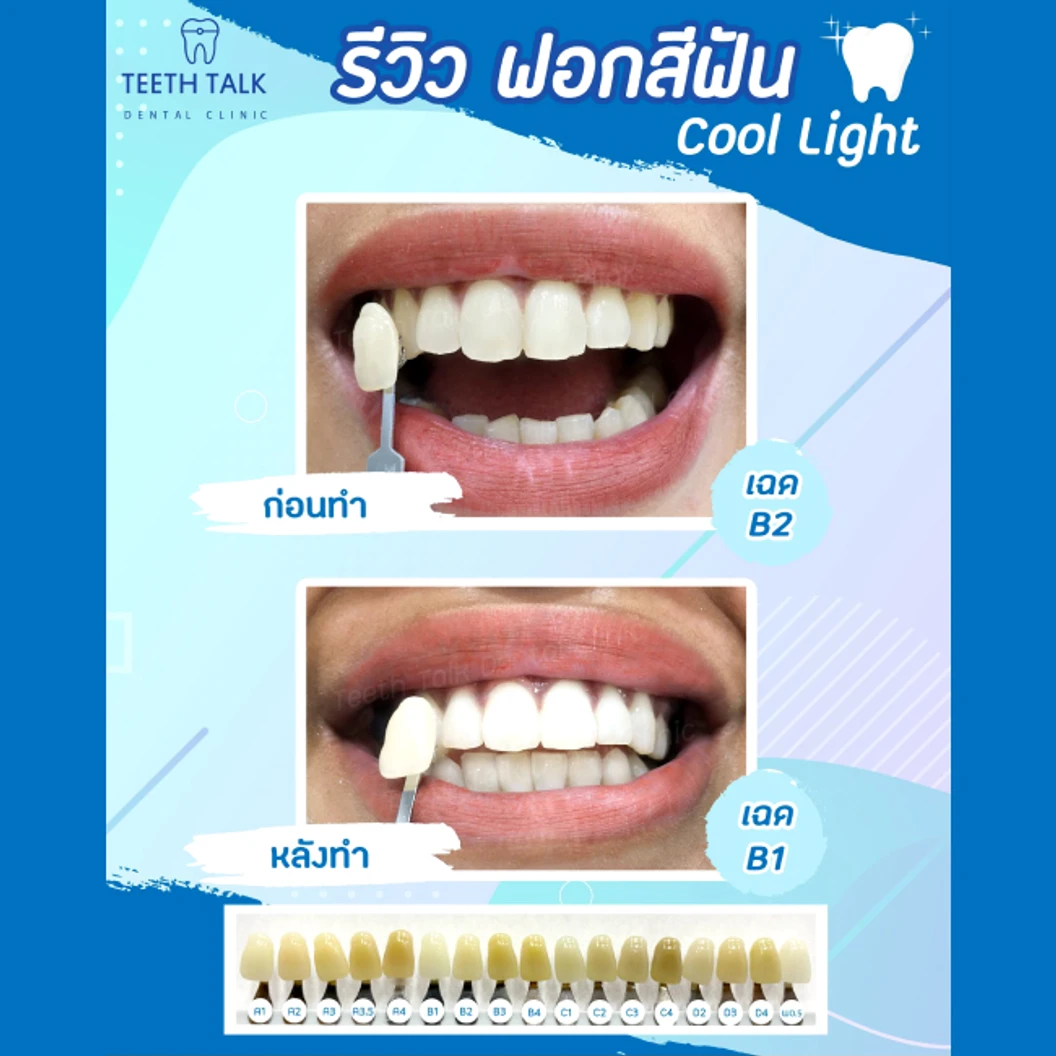 ฟอกสีฟันที่คลินิก ด้วยระบบ Cool Light ที่ Teeth Talk Dental Clinic