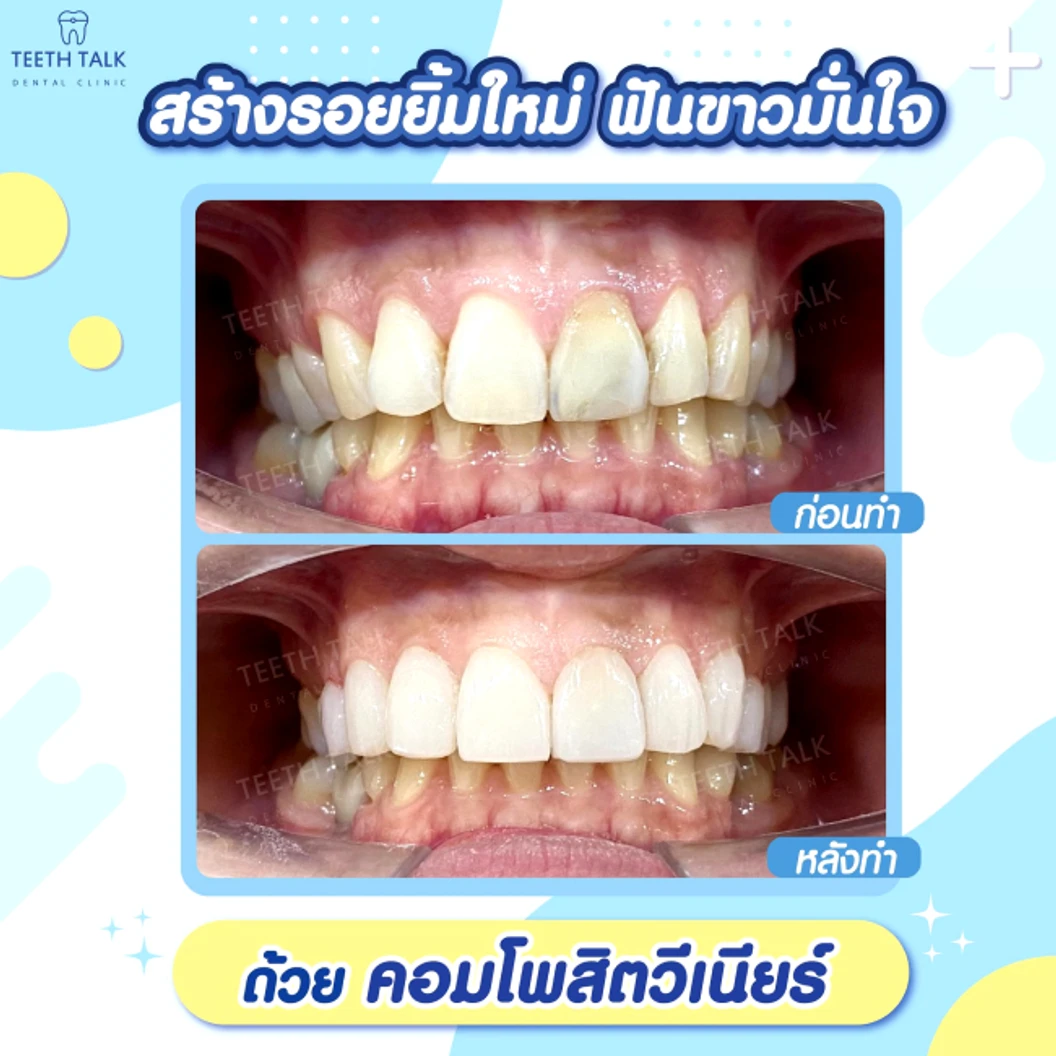 ทำวีเนียร์คอมโพสิต สำหรับฟัน 1 ซี่ ที่ Teeth Talk Dental Clinic