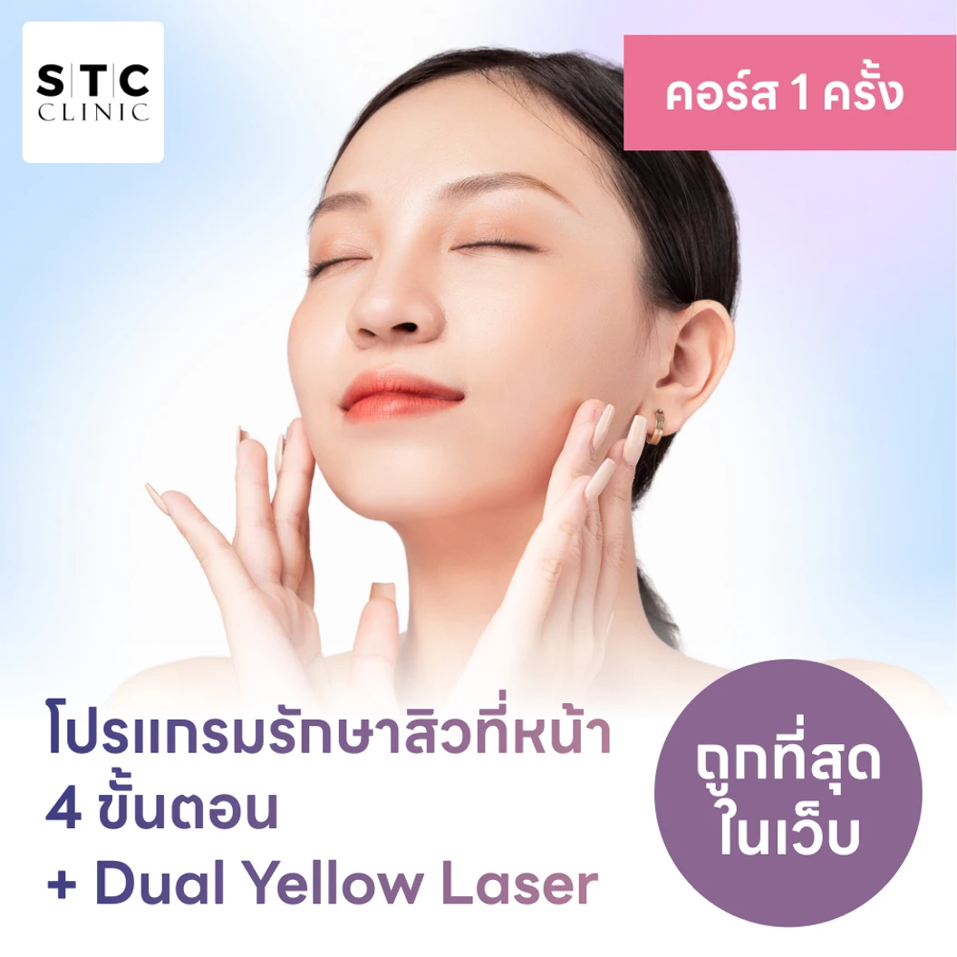 โปรแกรมรักษาสิวทั่วใบหน้า 4 ขั้นตอน พร้อมเลเซอร์ Dual Yellow ทั่วใบหน้า 1 ครั้ง แพ็กเกจ HDmall+ ที่ STC Anti-Aging & Wellness Clinic