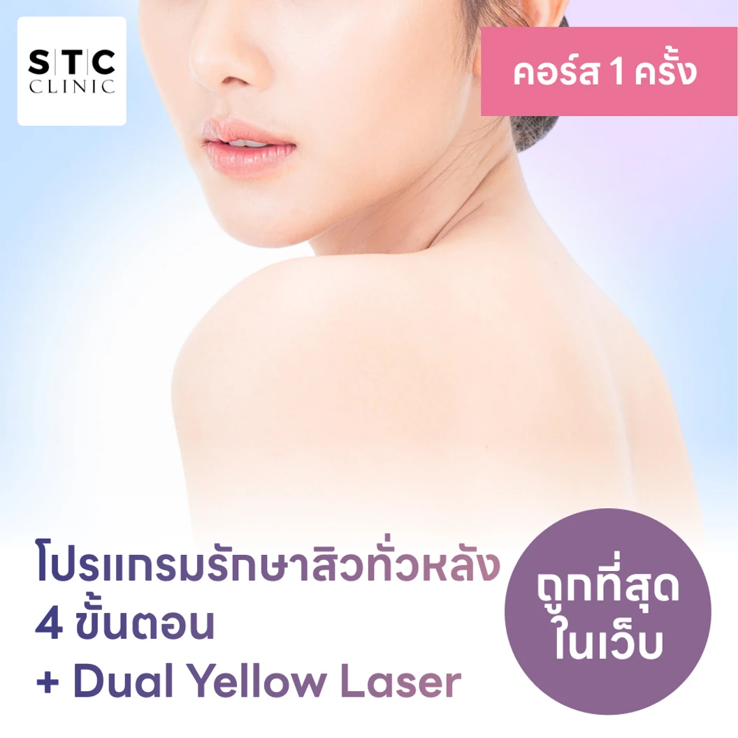 โปรแกรมรักษาสิวทั่วแผ่นหลัง 4 ขั้นตอน พร้อมเลเซอร์ Dual Yellow ทั่วแผ่นหลัง 1 ครั้ง แพ็กเกจ HDmall+ ที่ STC Anti-Aging & Wellness Clinic