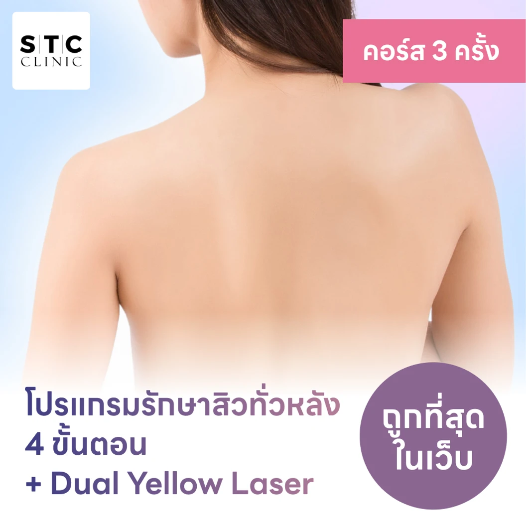 คอร์สโปรแกรมรักษาสิวทั่วแผ่นหลัง 4 ขั้นตอน พร้อมเลเซอร์ Dual Yellow ทั่วแผ่นหลัง 3 ครั้ง แพ็กเกจ HDmall+ ที่ STC Anti-Aging & Wellness Clinic