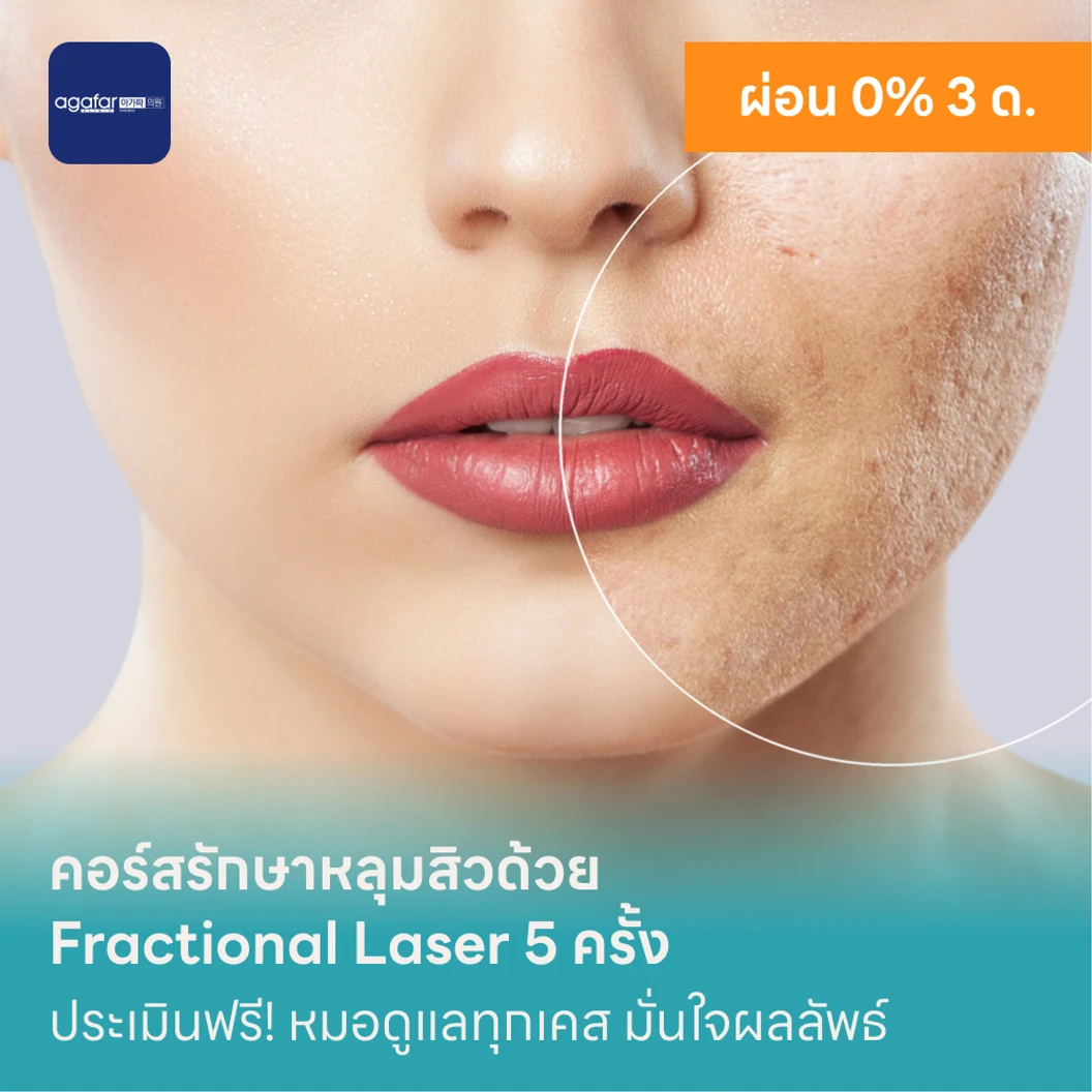 คอร์สรักษาหลุมสิวด้วย Fractional Laser 5 ครั้ง แพ็กเกจ HDmall+ ที่ Agafar Medical Clinic