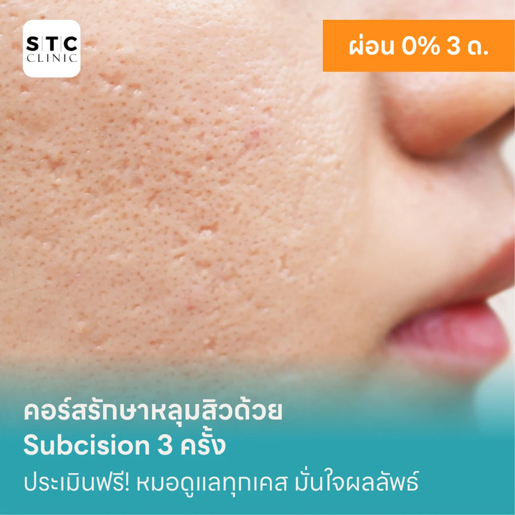 คอร์สรักษาหลุมสิวด้วย Subcision 3 ครั้ง แพ็กเกจ HDmall+ ที่ STC Anti-Aging & Wellness Clinic