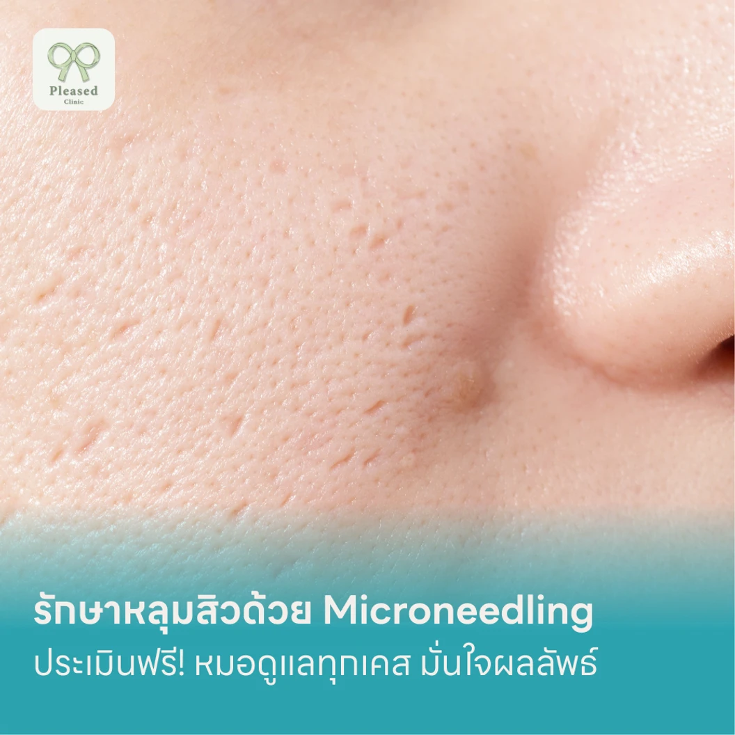 รักษาหลุมสิวด้วย Microneedling แพ็กเกจ HDmall+ ที่ Pleased Clinic พลีส คลินิก