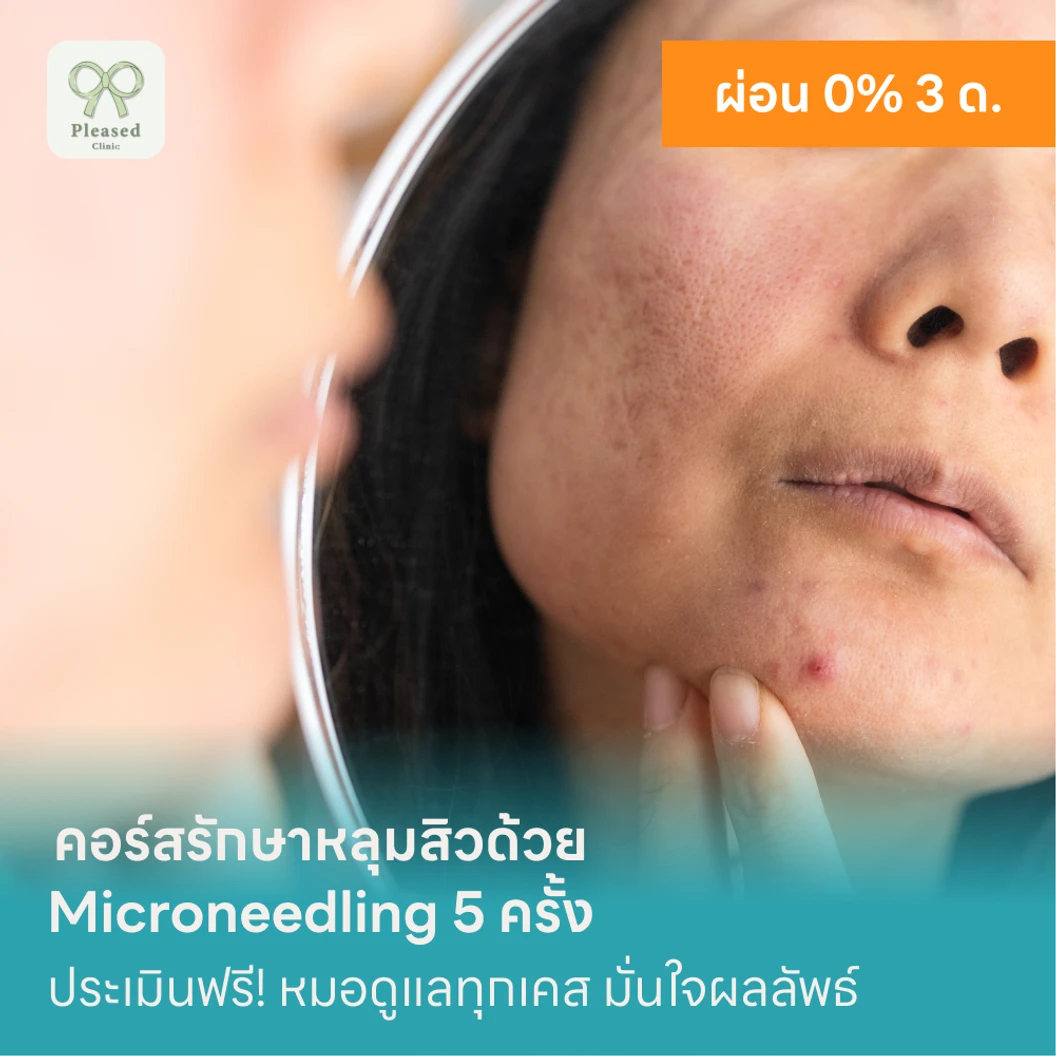 คอร์สรักษาหลุมสิวด้วย Microneedling 5 ครั้ง แพ็กเกจ HDmall+ ที่ Pleased Clinic พลีส คลินิก