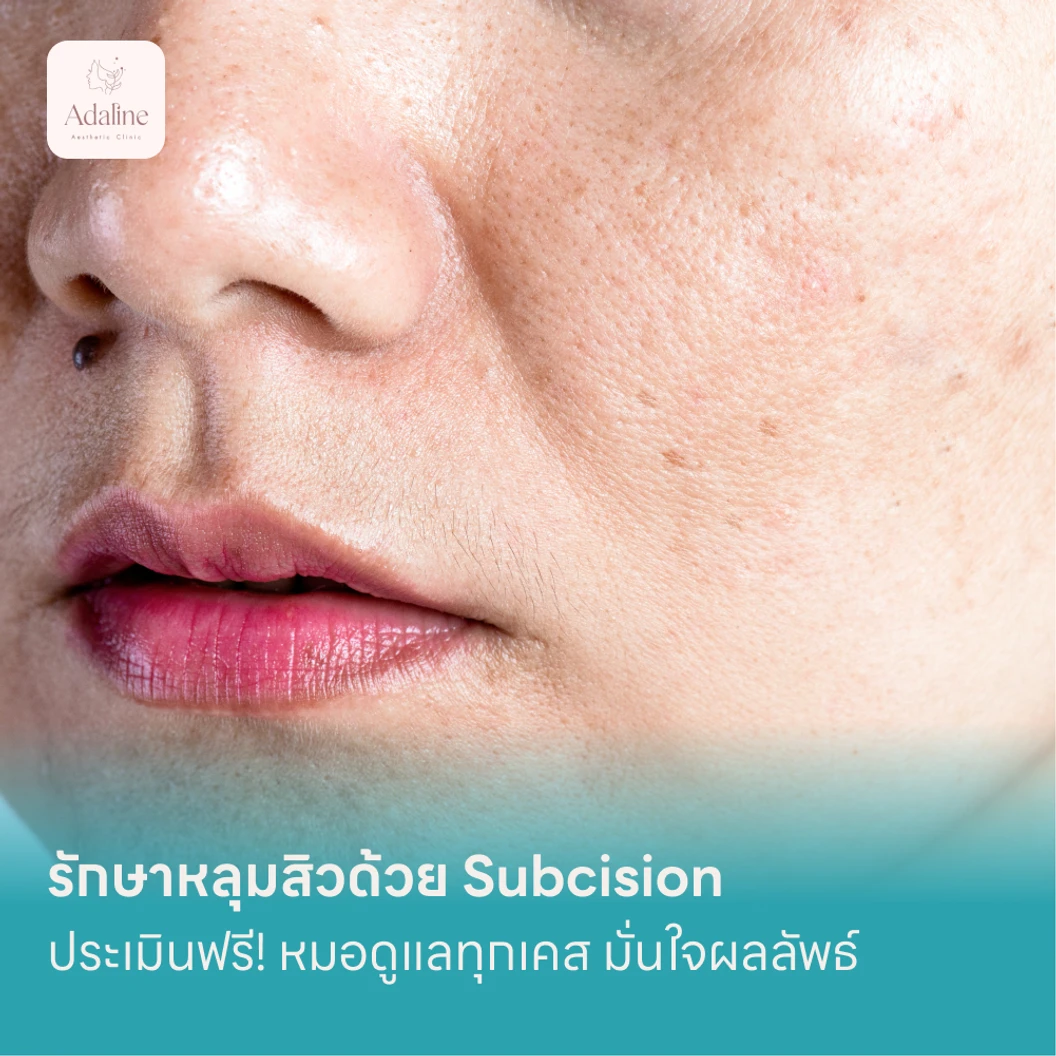 รักษาหลุมสิวด้วย Subcision แพ็กเกจ HDmall+ ที่ Adaline Aesthetic Clinic