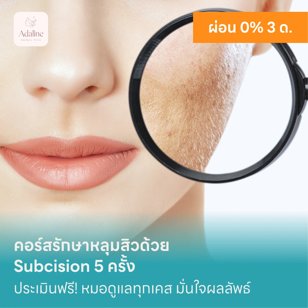 คอร์สรักษาหลุมสิวด้วย Subcision 5 ครั้ง แพ็กเกจ HDmall+ ที่ Adaline Aesthetic Clinic