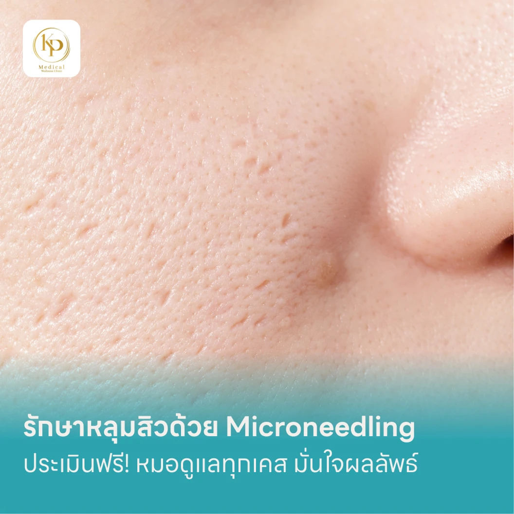 รักษาหลุมสิวด้วย Microneedling แพ็กเกจ HDmall+ ที่ KP Medical Wellness Clinic