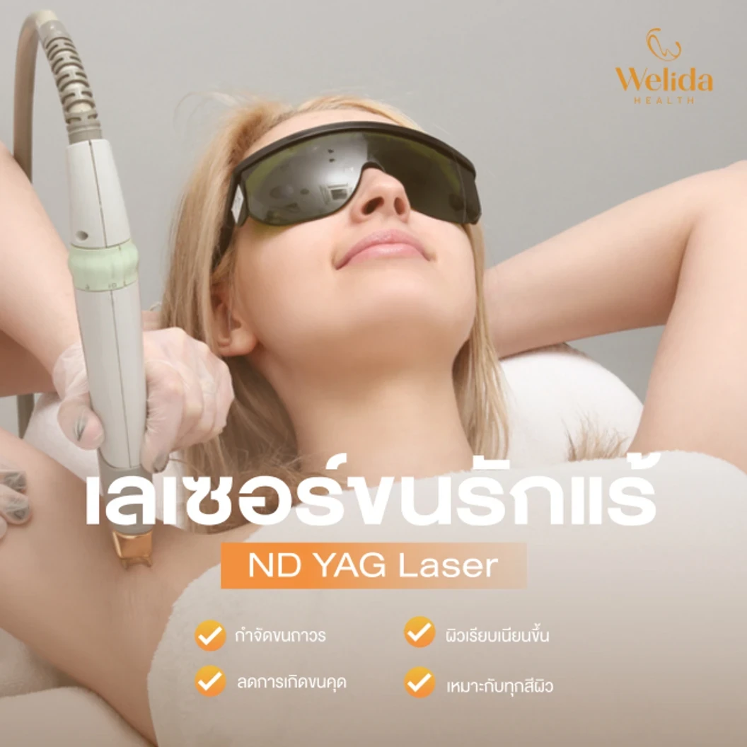 เลเซอร์ NdYAG กำจัดขนรักแร้ 1 ครั้ง ที่ Welida Health