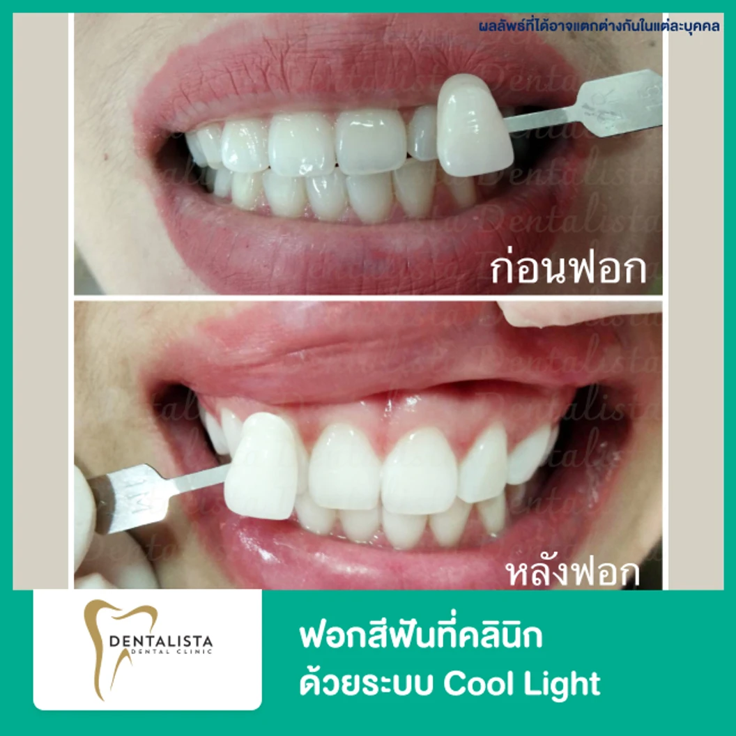 ฟอกสีฟันที่คลินิก ด้วยระบบ Cool Light  ที่ Dentalista Clinic