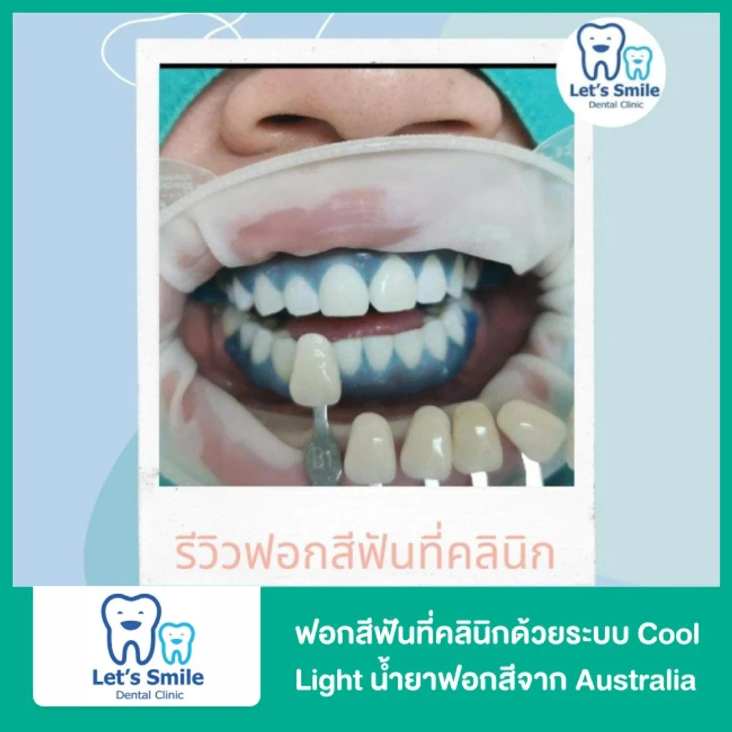 ฟอกสีฟันในคลินิกด้วยระบบ Cool Light น้ำยาฟอกสีนำเข้าจาก Australia ที่ Lets Smile Dental Clinic