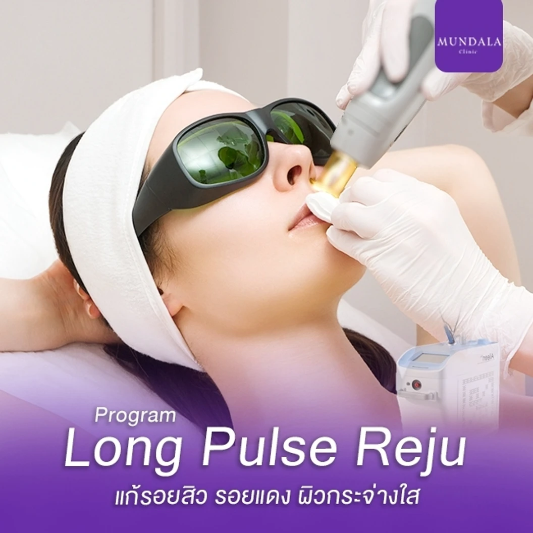 เลเซอร์ Long Pulse Reju หน้า แก้รอยสิว จำนวนช็อตขึ้นอยู่กับแพทย์ประเมิน ที่ Mundala Clinic