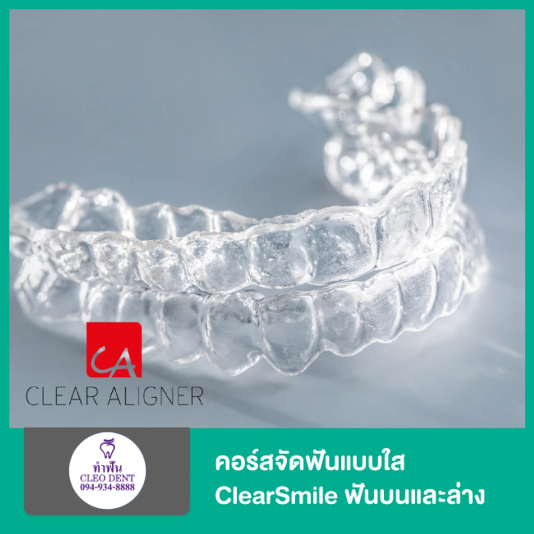 คอร์สจัดฟันแบบใส ClearSmile ฟันบนและล่าง ที่ Cleo Dent Dental Clinic