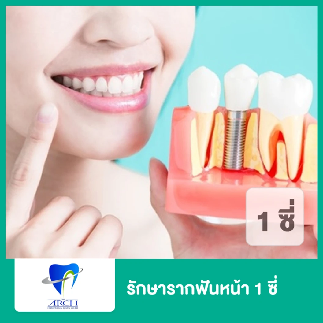 รักษารากฟันหน้า 1 ซี่ ที่ The ARCH Dental Center ศูนย์ทันตกรรมดิอาร์ช