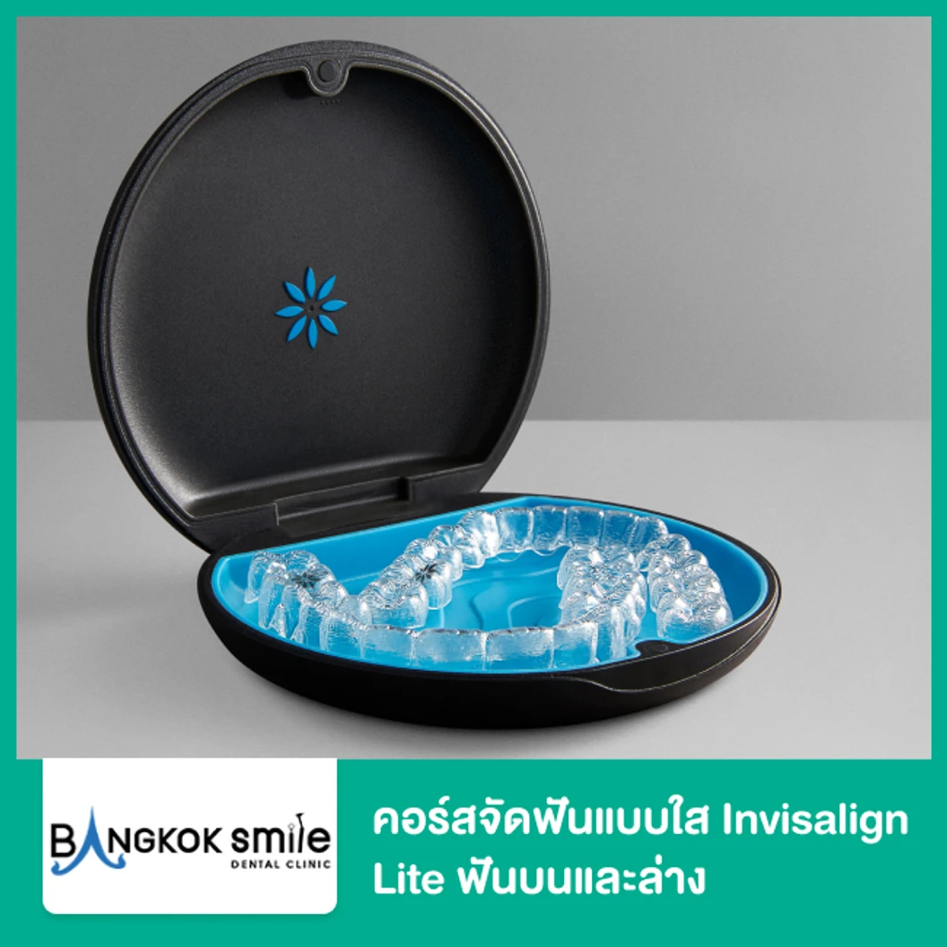 คอร์สจัดฟันแบบใส Invisalign Lite ฟันบนและล่าง เครื่องมือ 14 ชิ้น ที่ Bangkok Smile Dental