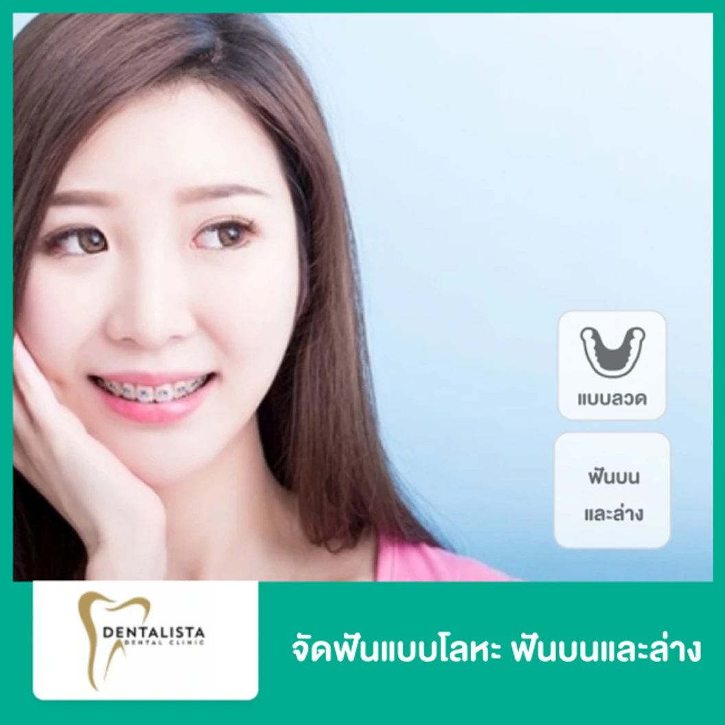 จัดฟันแบบโลหะ ฟันบนและล่าง ที่ Dentalista Clinic