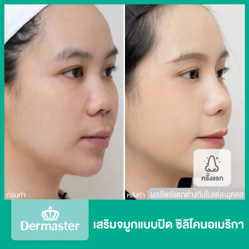 เสริมจมูกแบบปิด ด้วยซิลิโคนอเมริกาพรีเมียม สำหรับเคสเสริมใหม่ ที่ Dermaster