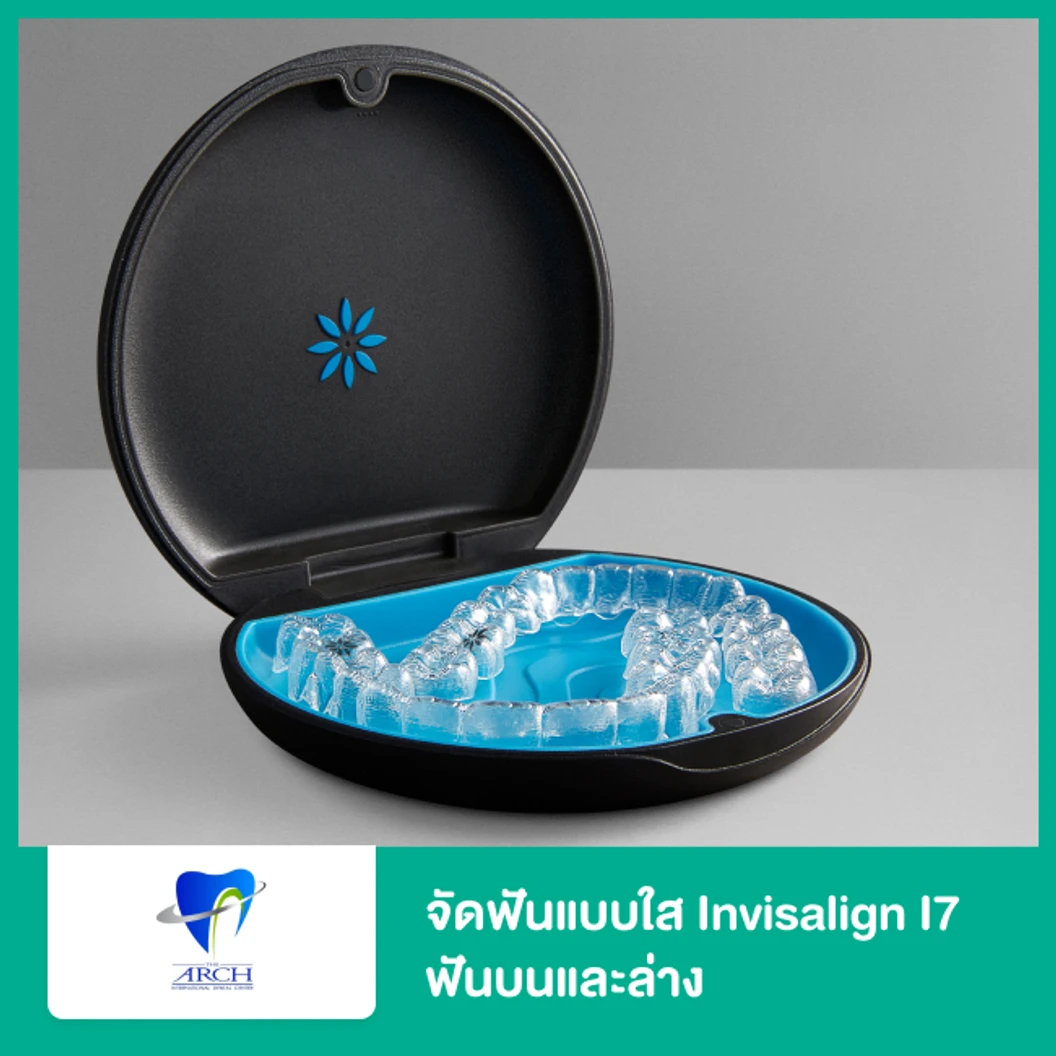 จัดฟันแบบใส Invisalign i7 ฟันบนและล่าง ที่ The ARCH Dental Center ศูนย์ทันตกรรมดิอาร์ช