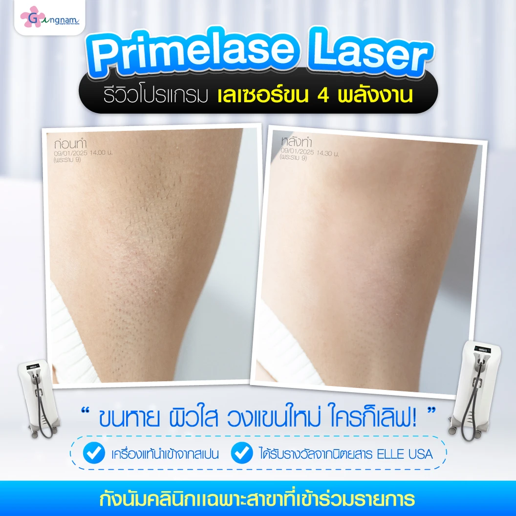 คอร์สเลเซอร์กำจัดขนรักแร้ 4 พลังงาน เครื่องแท้ Primelase จากสเปน 12 ครั้ง ภายใน 1 ปี 1 สิทธิ์ ท่าน ที่ Gangnam Clinic