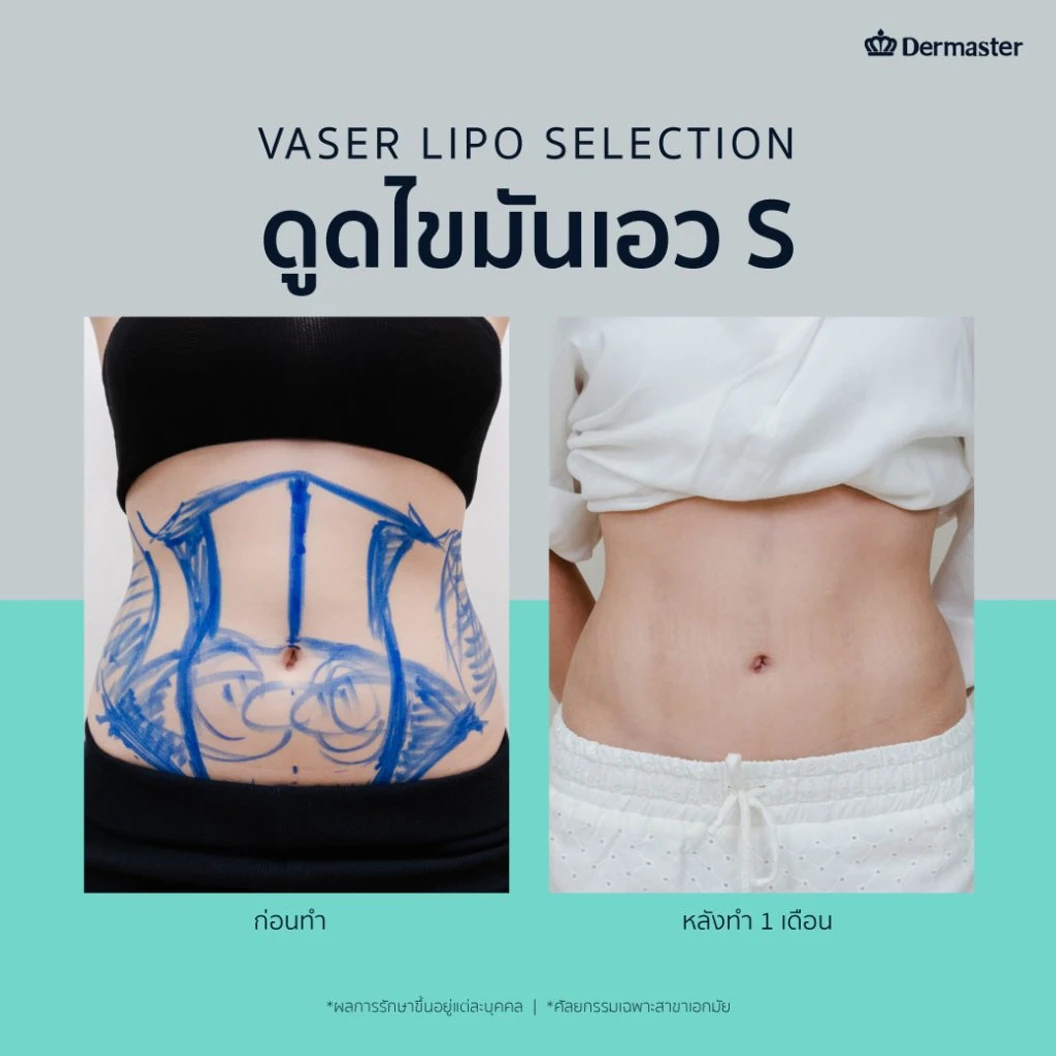 โปรแกรมดูดไขมันด้วยเครื่อง Vaser 4 จุด 1 ครั้ง สำหรับผู้ที่ BMI ไม่เกิน 25 ที่ Dermaster