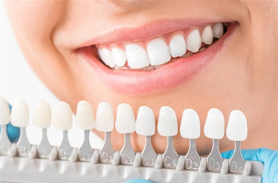 ทำวีเนียร์แบบเซรามิกหรือพอร์ซเลน 1 ซี่ ที่ Bangkok Dental Care