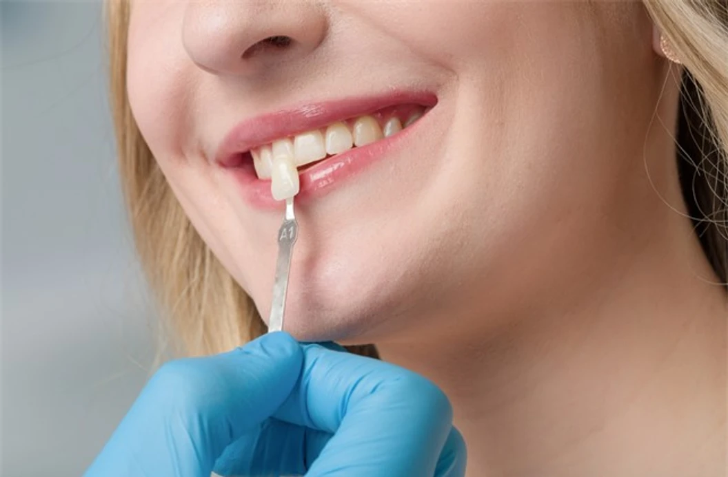 ทำวีเนียร์แบบเรซินคอมโพสิต 1 ซี่ ที่ Bangkok Dental Care