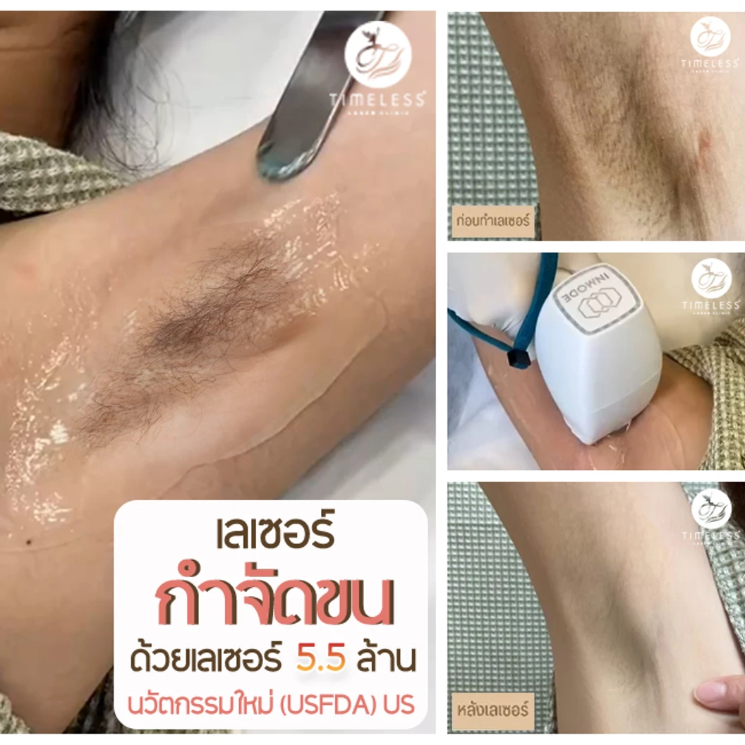 เลเซอร์ Diode กำจัดขน + เลเซอร์ Lumecca ปรับสีผิวรักแร้ 1 ครั้ง ทดลองครั้งแรก ผู้หญิงเท่านั้น ที่ Timeless Laser Clinic