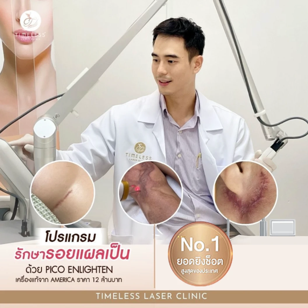 เลเซอร์ลบรอยแผลเป็น แผลอุบัติเหตุ แผลคีลอยด์ หรือแผลศัลยกรรม บริเวณที่ต้องการ ด้วยเครื่อง Pico Enlighten บริเวณที่ต้องการ 1 บริเวณ 300 ช็อต 1 ครั้ง ที่ Timeless Laser Clinic