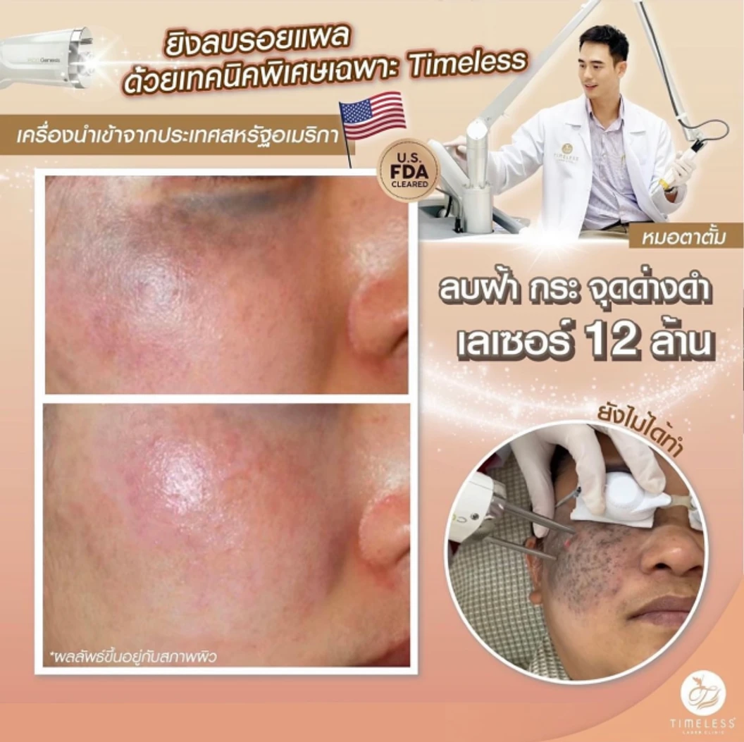 เลเซอร์แก้ปัญหาผิวทั่วใบหน้า ด้วยเครื่อง Pico Enlighten ไม่จำกัดช็อตขึ้นอยู่กับแพทย์ประเมิน ทำได้ทุกโหมด รอยสิว และหลุมสิว 1 ครั้ง ที่ Timeless Laser Clinic