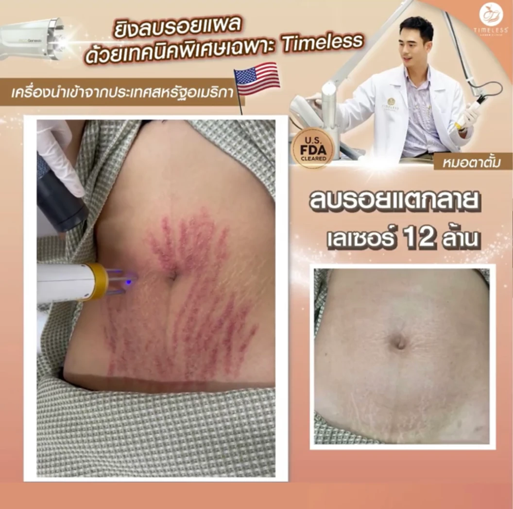 เลเซอร์ลดรอยแตกลายขาว ดำและแดง บริเวณที่ต้องการ 1 บริเวณ ด้วยเลเซอร์ Pico Enlighten 300 ช็อต 1 ครั้ง ที่ Timeless Laser Clinic