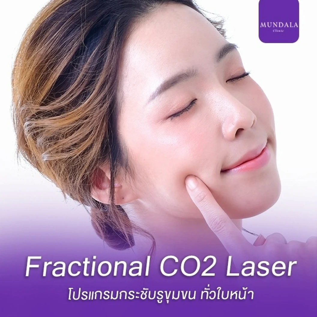 เลเซอร์ Fractional CO2 กระชับรูขุมขนหน้า ที่ Mundala Clinic