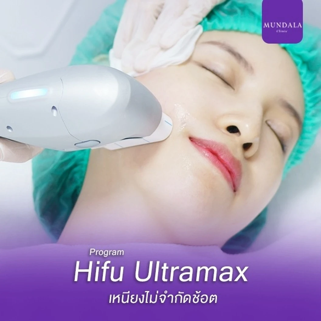 โปรแกรม HIFU Ultramax เหนียง จำนวนช็อตขึ้นอยู่กับแพทย์ประเมิน ที่ Mundala Clinic