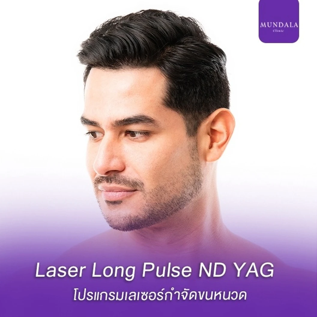 เลเซอร์ Long Pulse NdYAG กำจัดขนหนวด 1 ครั้ง ที่ Mundala Clinic