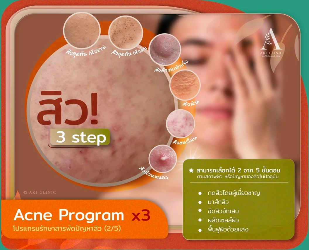 Acne Program โปรแกรมรักษาสิว 2 ขั้นตอน 1 ครั้ง ที่ Aki Clinic