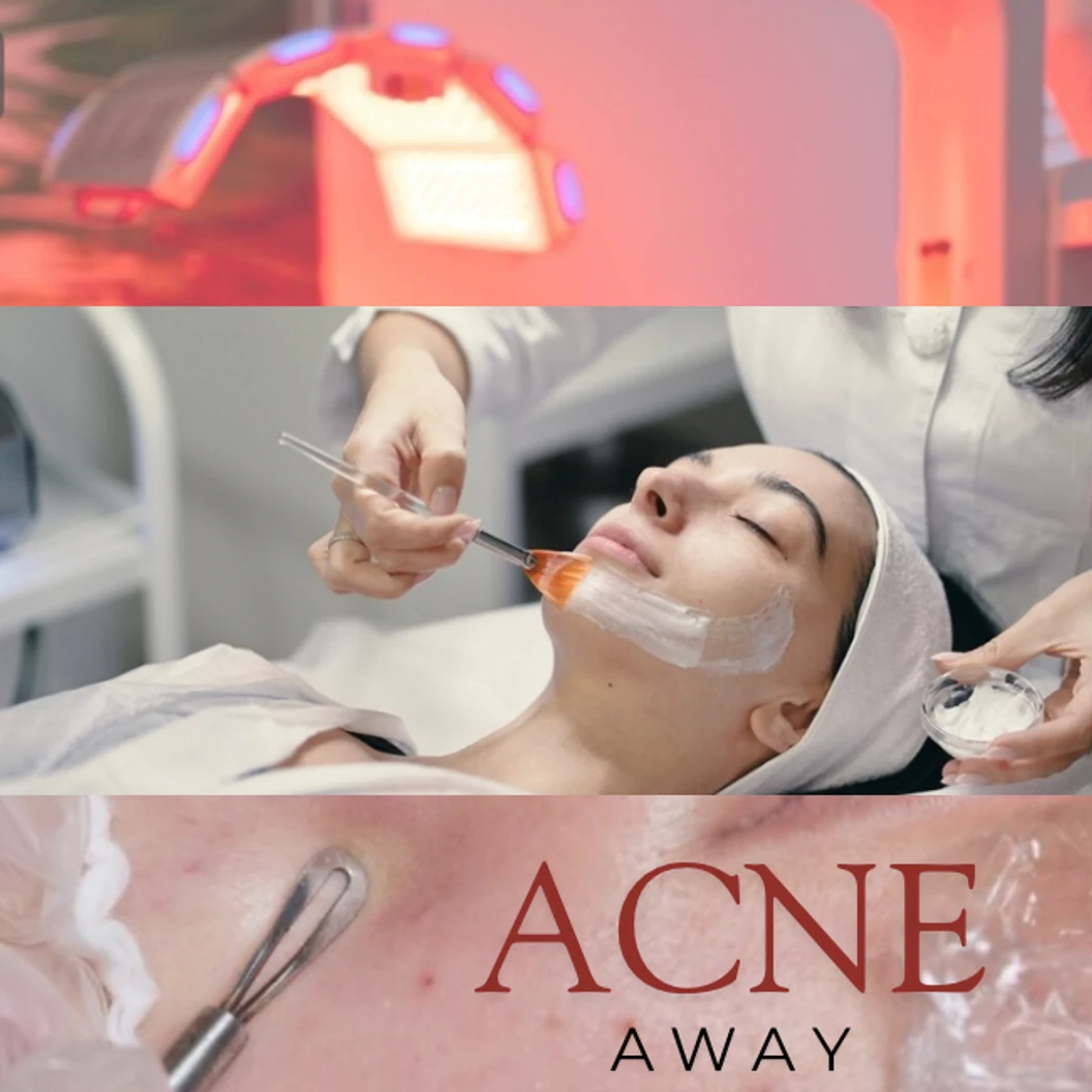 รักษาสิวหน้า 4 ขั้นตอน Acne Away ที่ Skinhub Clinic