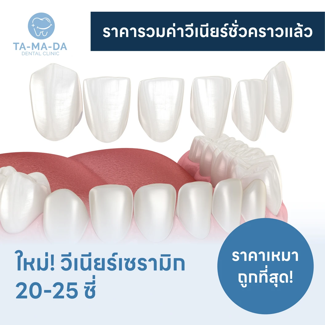 ทำวีเนียร์เซรามิก Amber 20-25 ซี่ ราคาเหมา แพ็กเกจ HDcare Lite ที่ Tamada Clinic ธรรมดาคลินิก