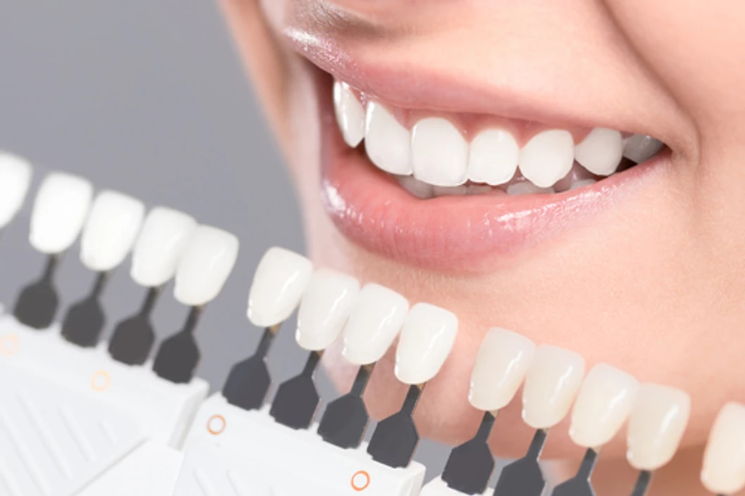 เคลือบผิวฟันและแปะฟันขาว ด้วยวีเนียร์เซรามิกหรือพอร์ซเลน eMax 1 ซี่ ที่ Smile Signature คลินิกทันตกรรมสไมล์ ซิกเนเจอร์