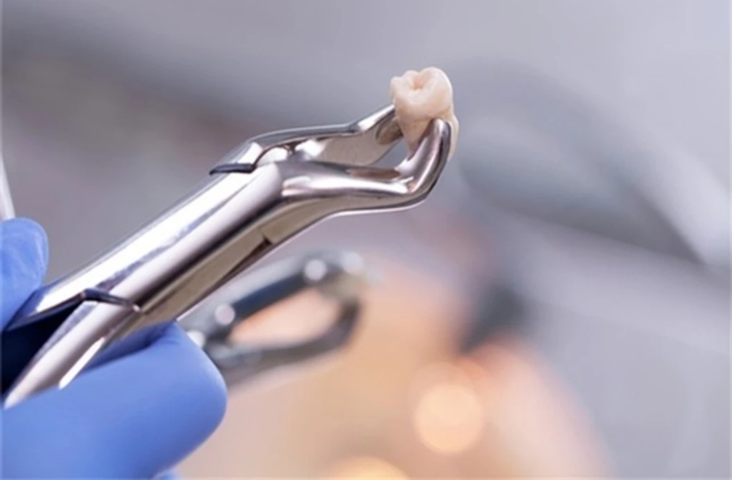 ถอนฟันอย่างยาก เช่น ถอนฟันคุด 1 ซี่ ที่ Bangkok Smile Dental