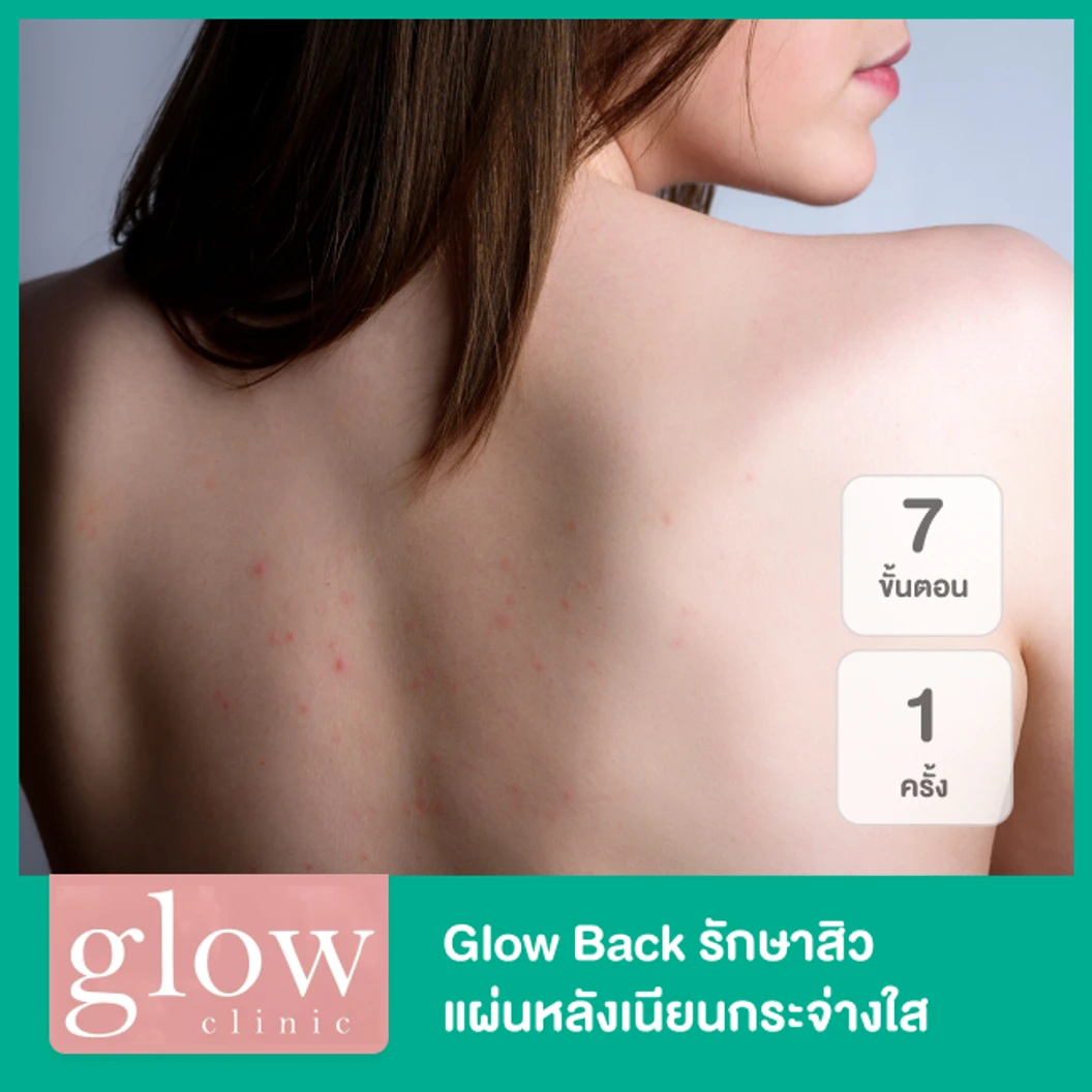 Glow Back รักษาสิว แผ่นหลังเนียนกระจ่างใส ใน 7 ขั้นตอน 1 ครั้ง ที่ Glow Clinic Thailand