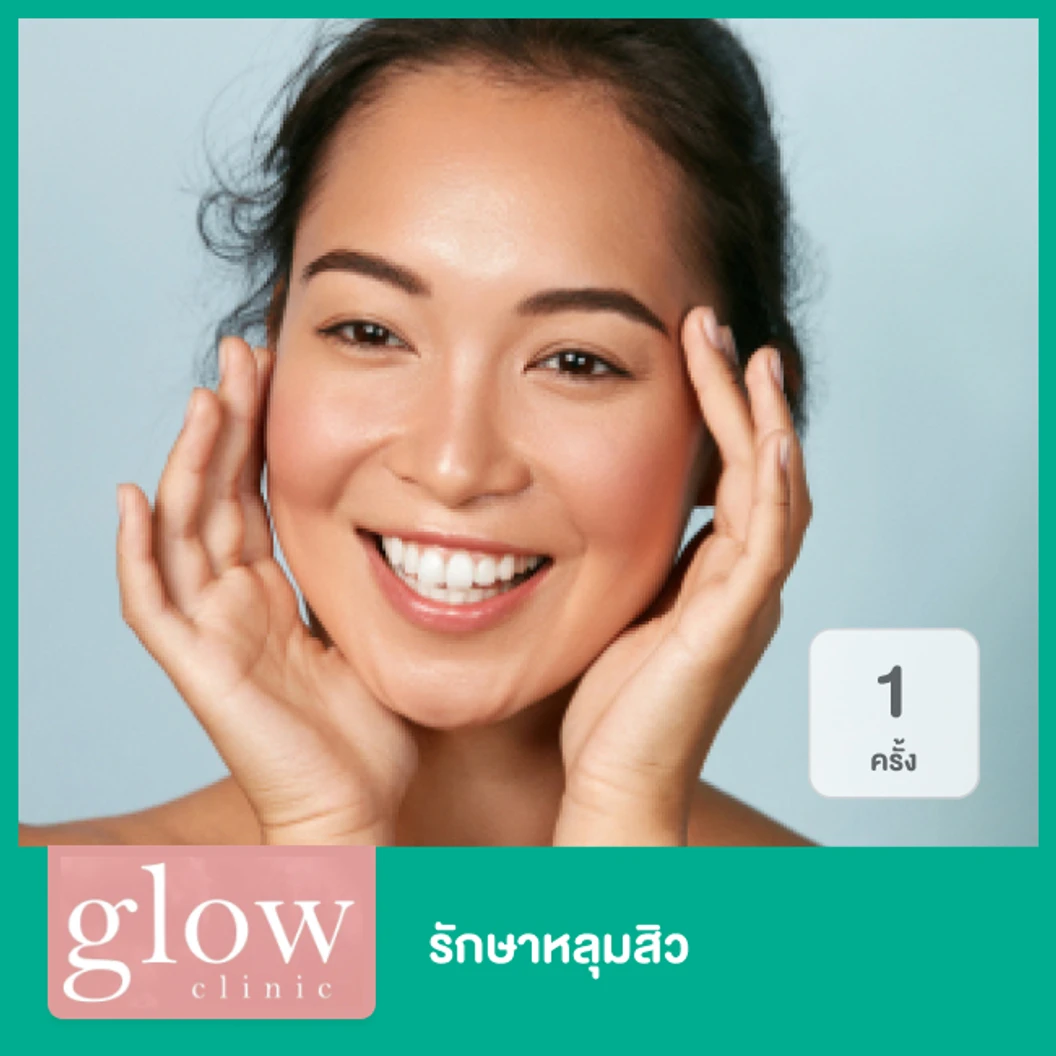 รักษาหลุมสิว ด้วยเทคนิค Subcision 1 ครั้ง ที่ Glow Clinic Thailand