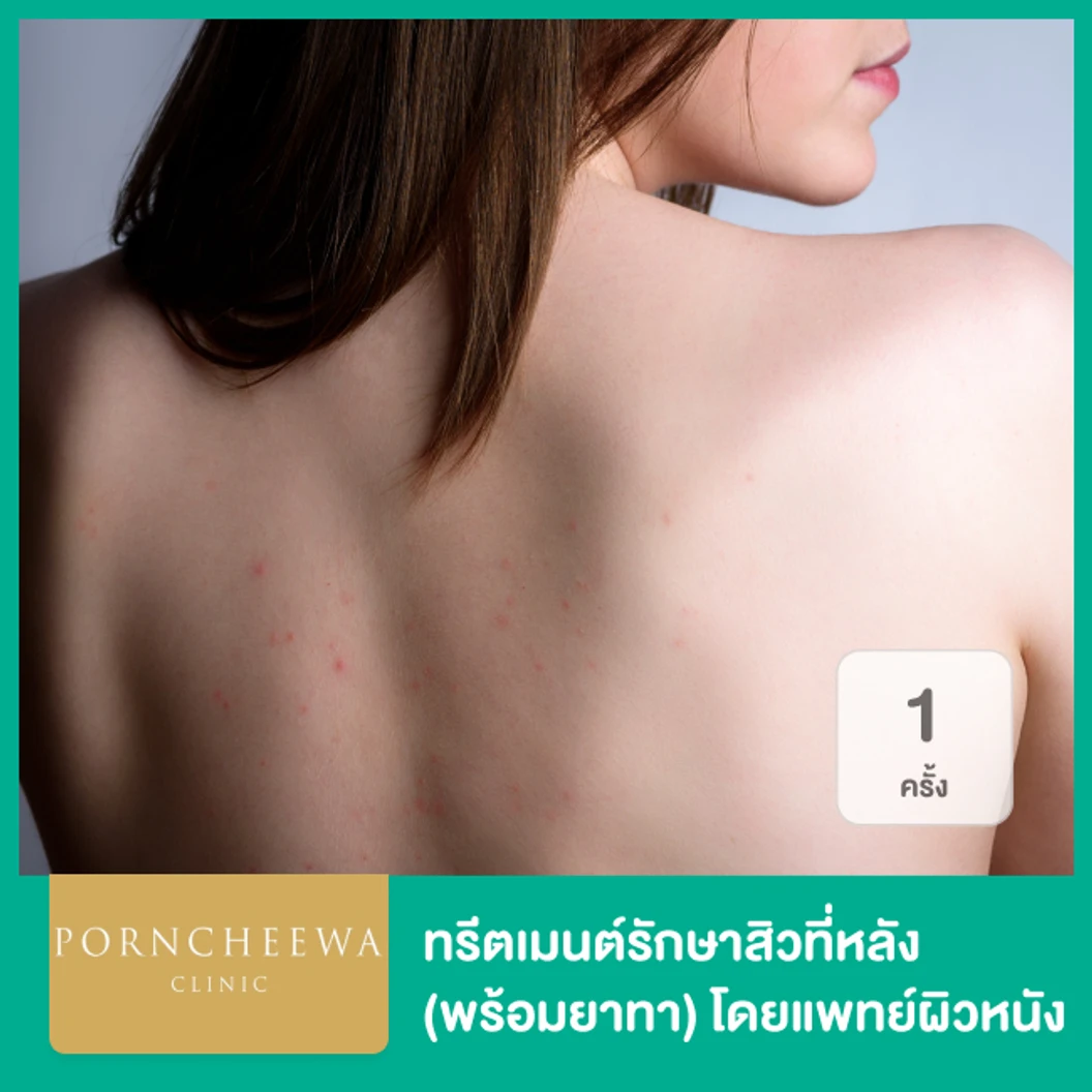 ทรีตเมนต์รักษาสิวที่หลัง พร้อมยาทา โดยแพทย์ผิวหนัง 1 ครั้ง ที่ Porncheewa Clinic