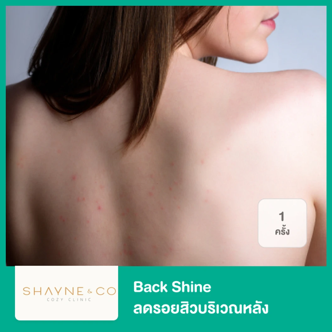 Back Shine ลดรอยสิวบริเวณหลัง 1 ครั้ง ที่ Shayne & Co. Clinic